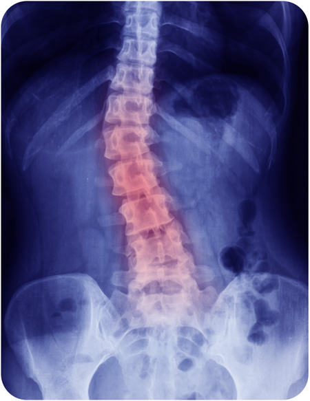 Scoliosis, Cloverfield, Chiropractor Holywood